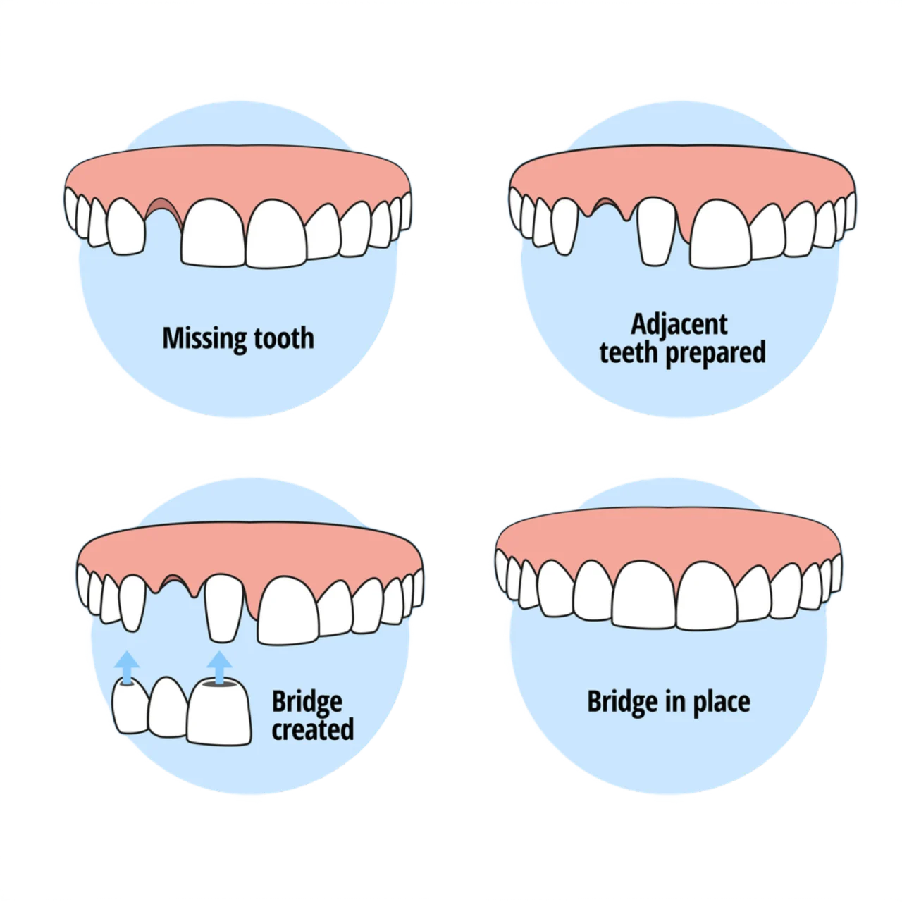 Come funzionano i ponti e le corone dentali