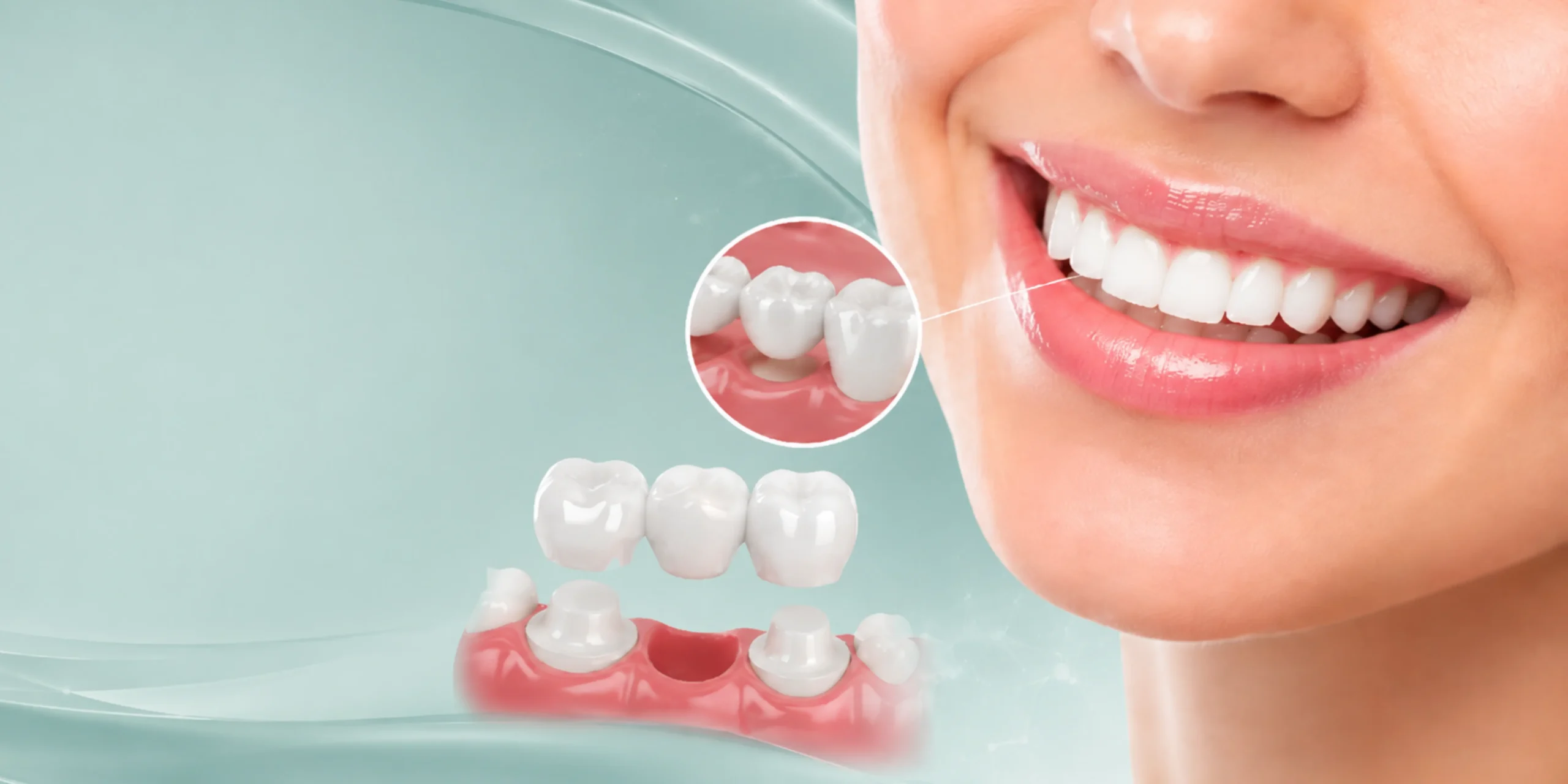 All-on-4 and All-on-6 dental implants in Albania at Andent Tirana