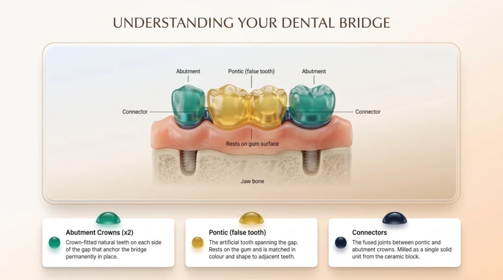 Diagramma di un ponte dentale a 3 elementi con corone pilastro su denti naturali e pontico centrale sopra la gengiva
