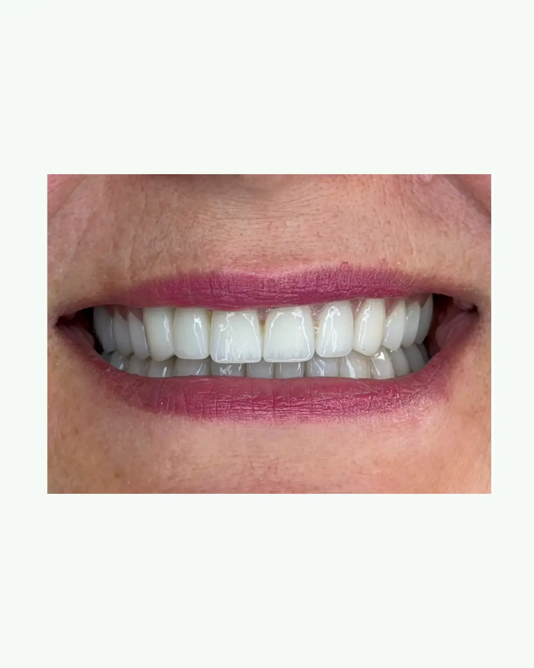 After successful clear aligners and cosmetic dental bonding at Andent Clinic Tirana