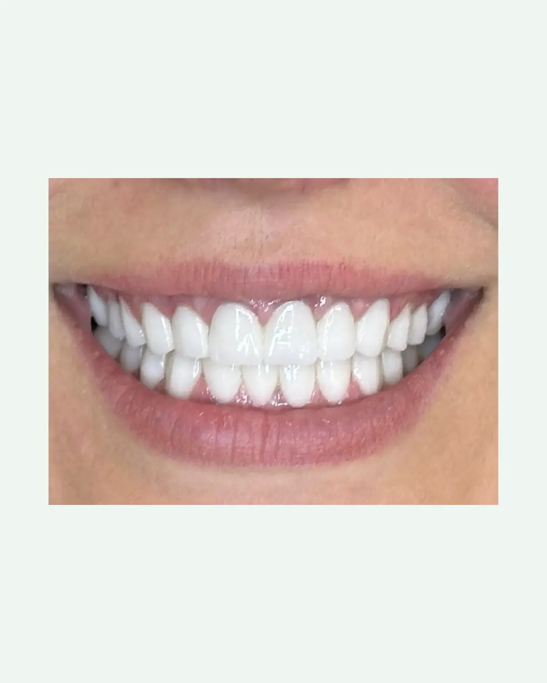 After premium full arch dental implant restoration at Andent Clinic Albania