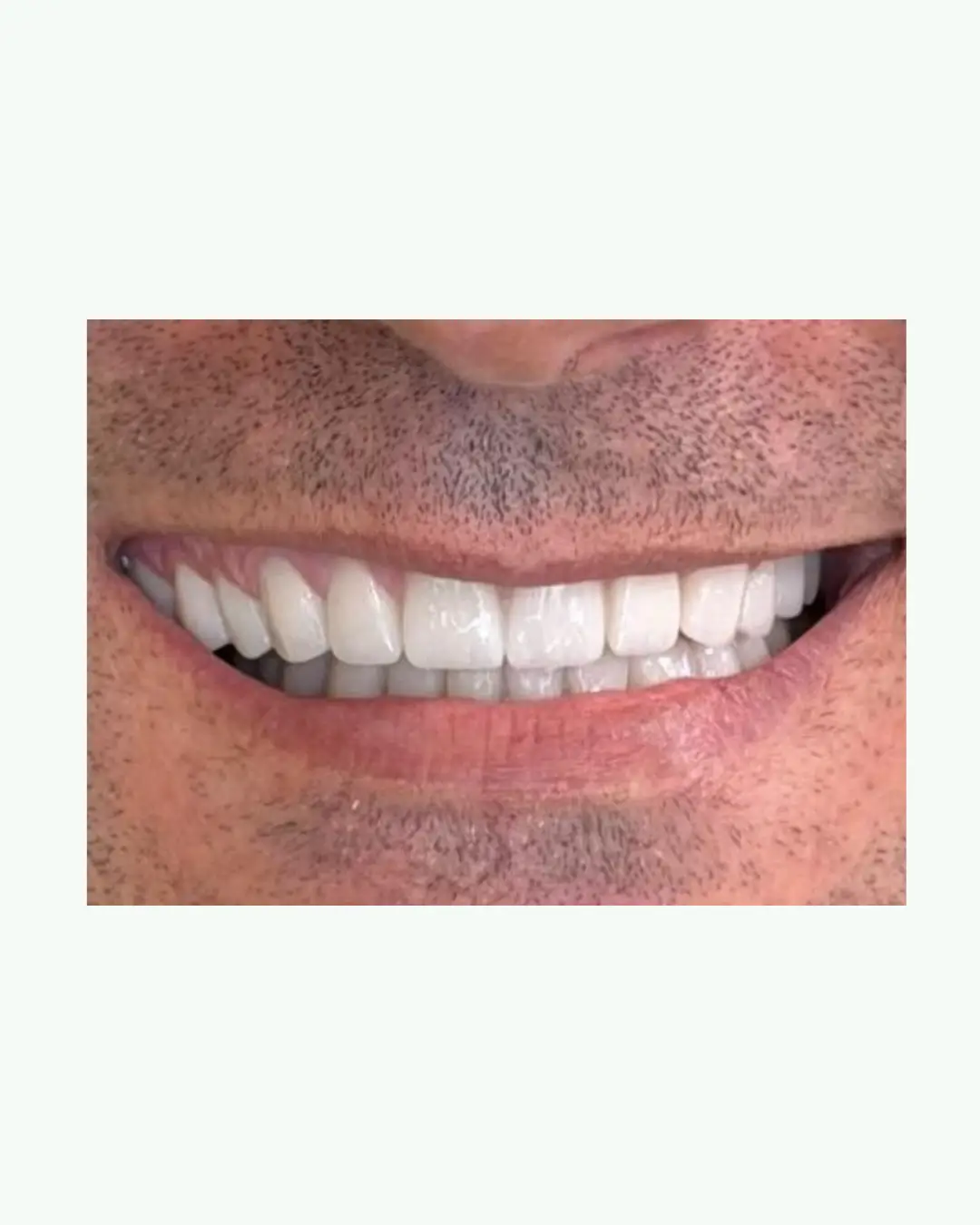 After metal-free zirconia crowns and dental bridge fabrication in Albania