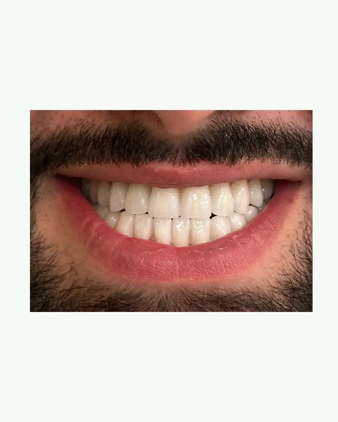 After fixed All-on-6 dental implant bridge completed in Tirana Europe