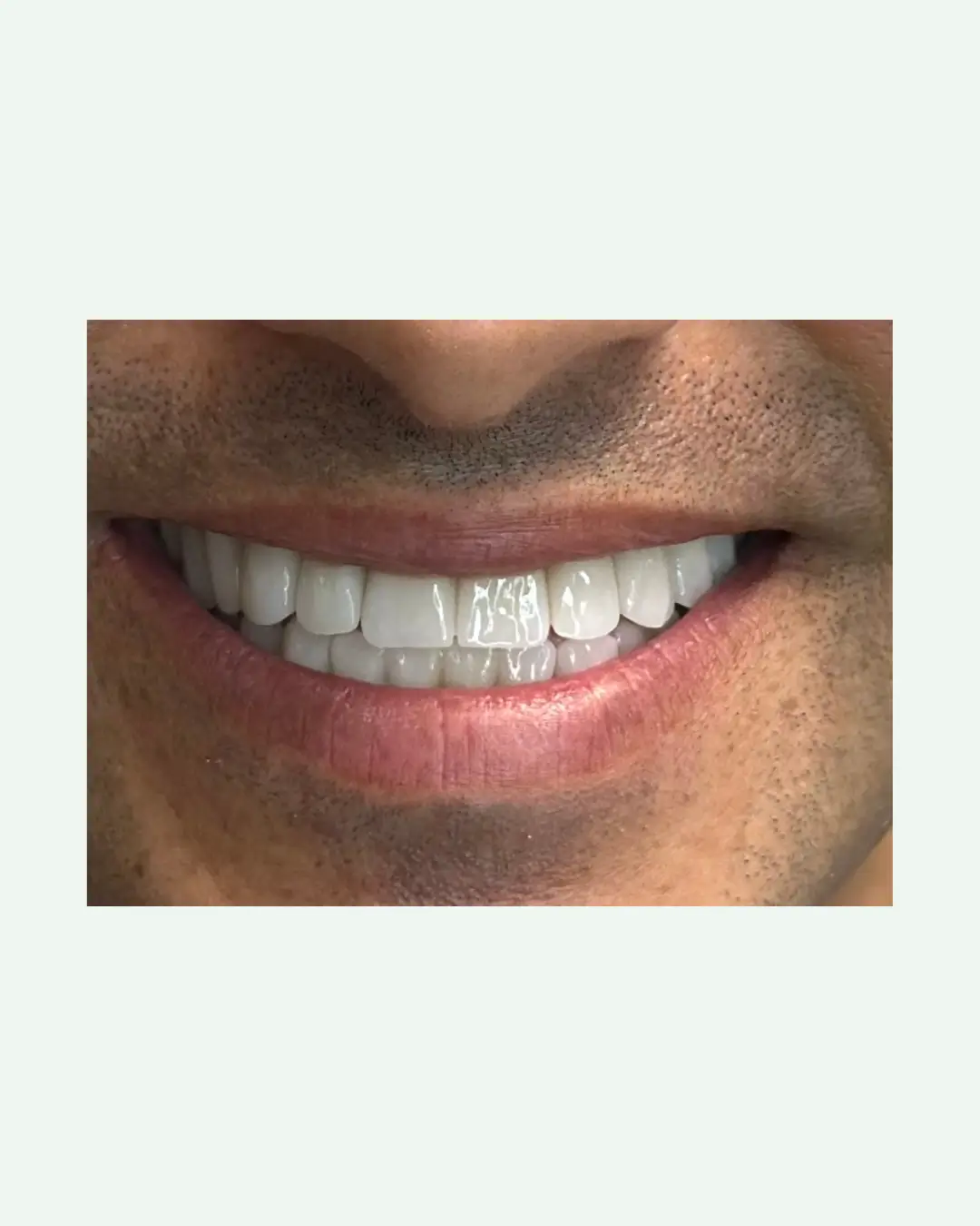 After affordable premium dental implant and zirconia crown placement in Albania