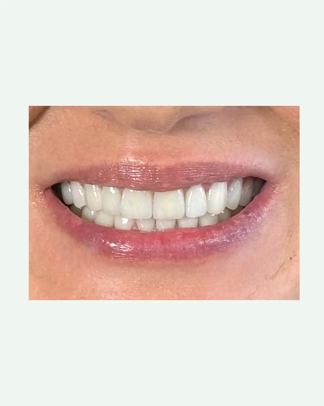 After natural E.max porcelain veneers smile transformation in Tirana