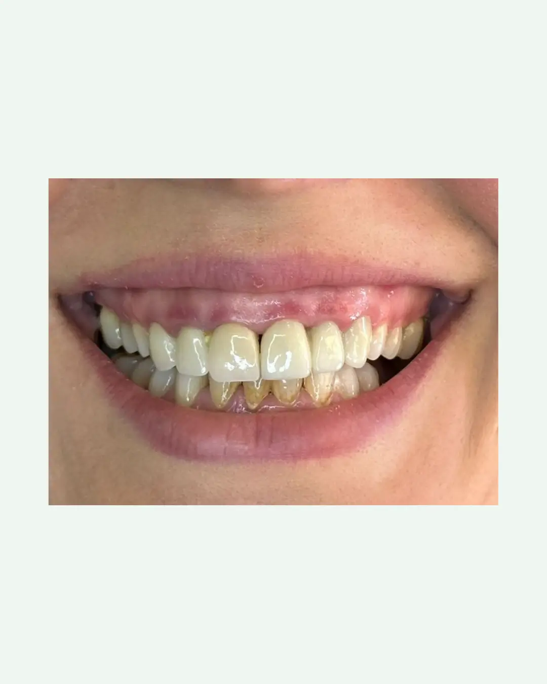 Before full arch dental implant rehabilitation prior to treatment in Tirana