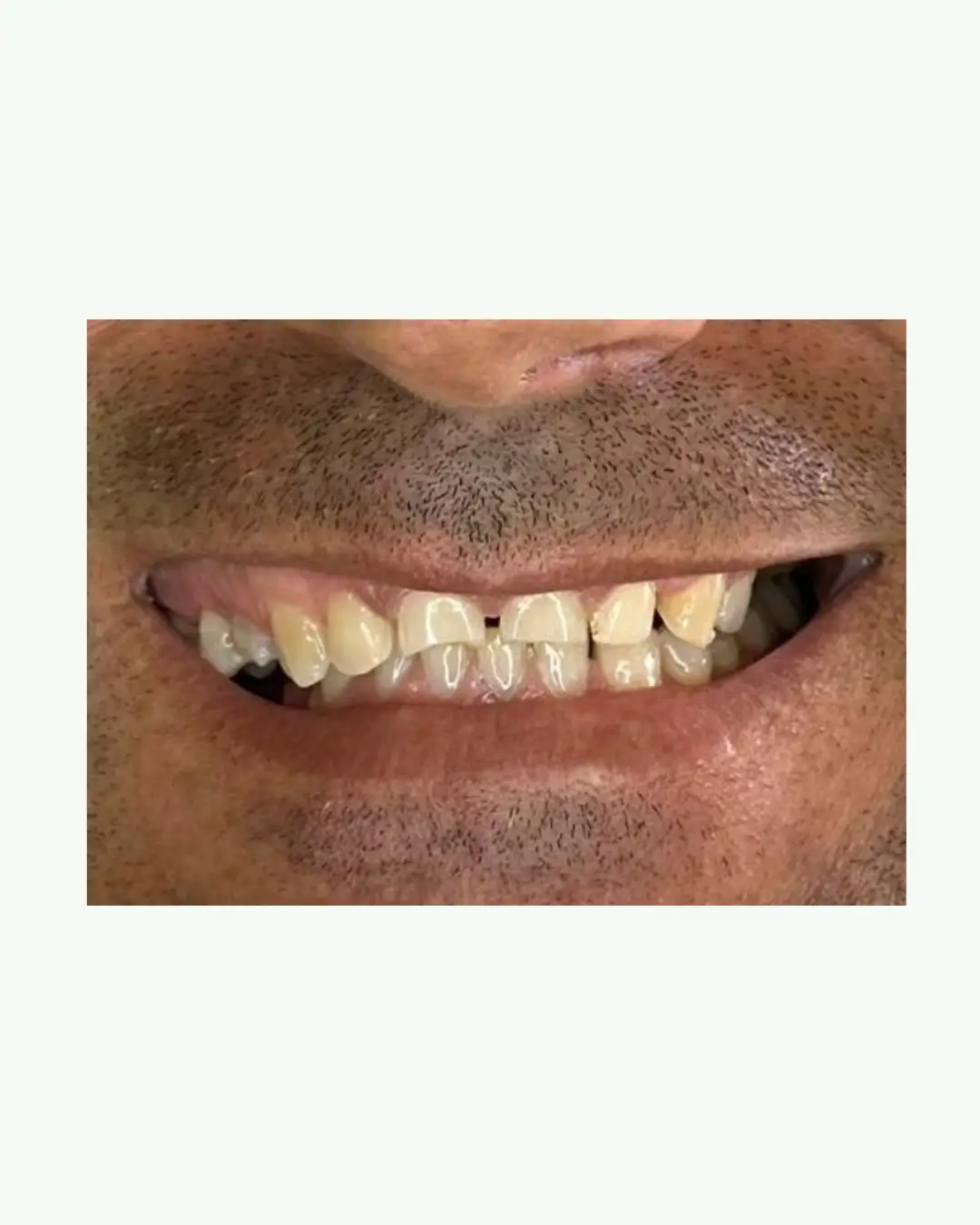 Before full dental crown and bridge restoration for European dental tourism patient