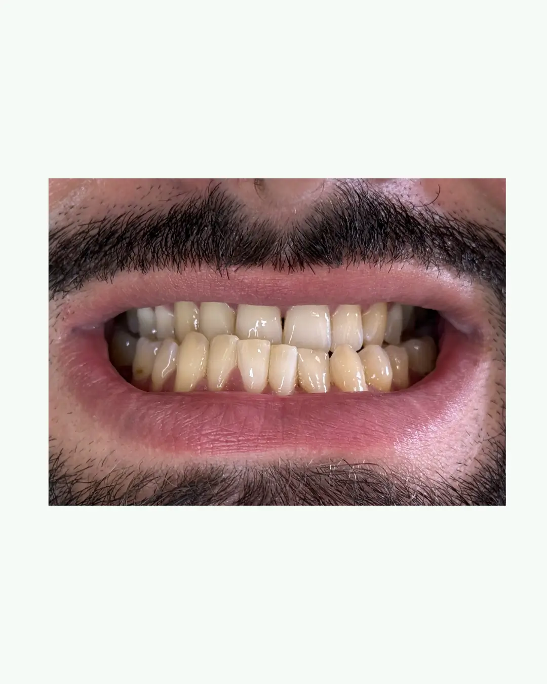 Before All-on-6 upper arch dental implants treatment for international patient