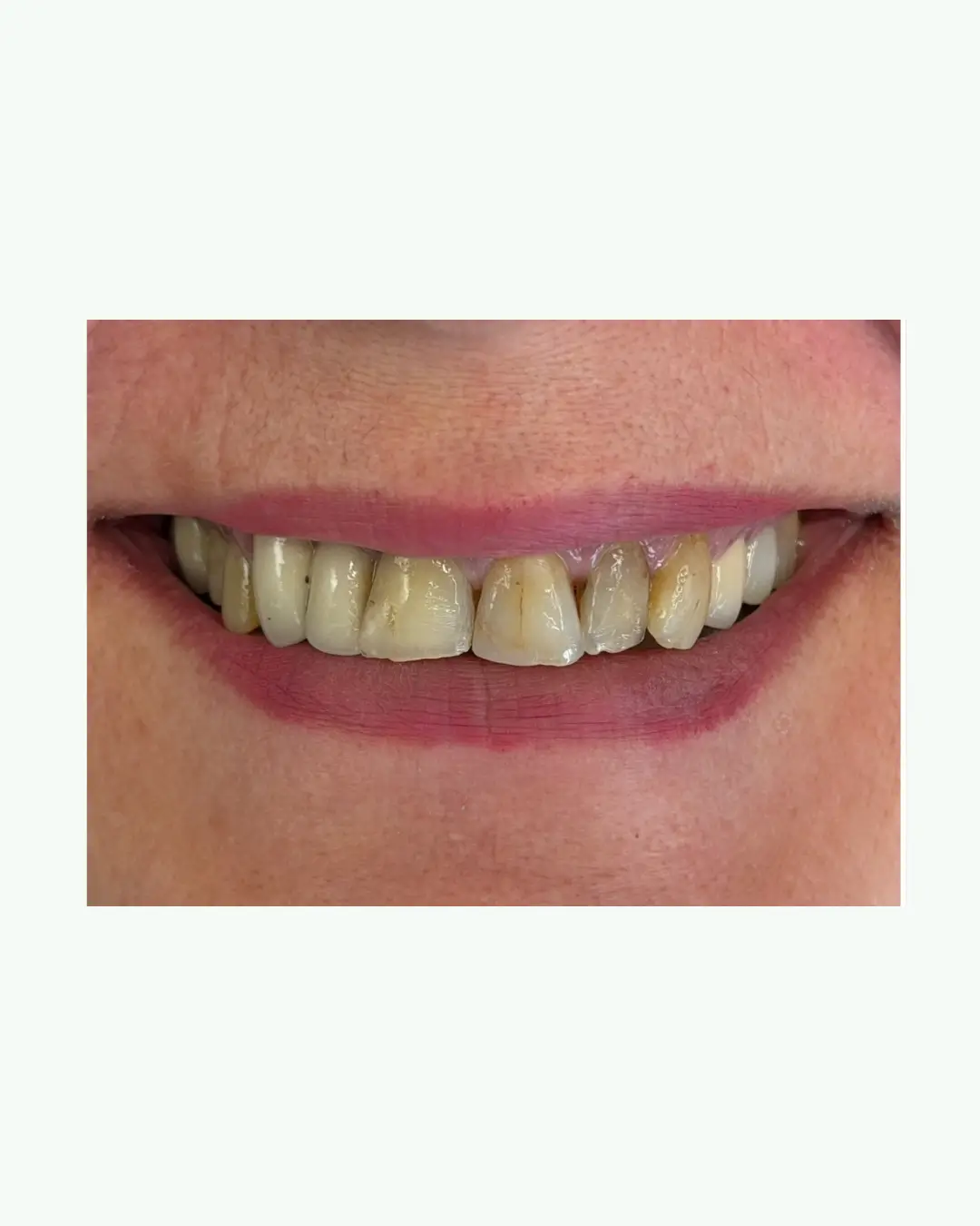 Before clear aligners orthodontics and composite bonding treatment