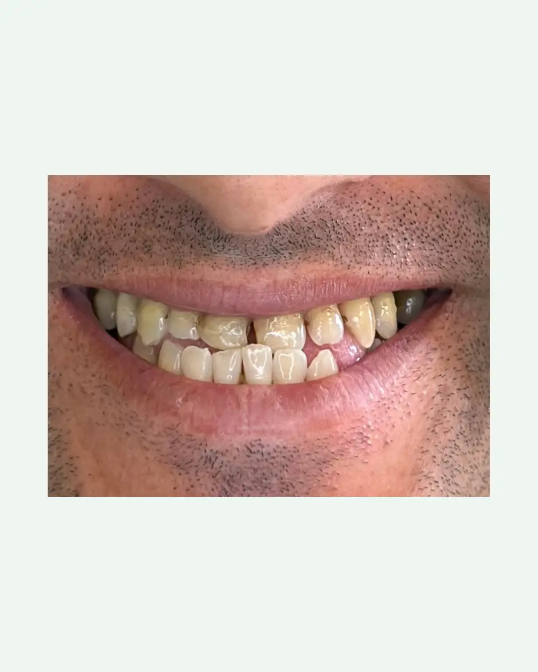 Before single dental implant and crown procedure at Tirana dental clinic