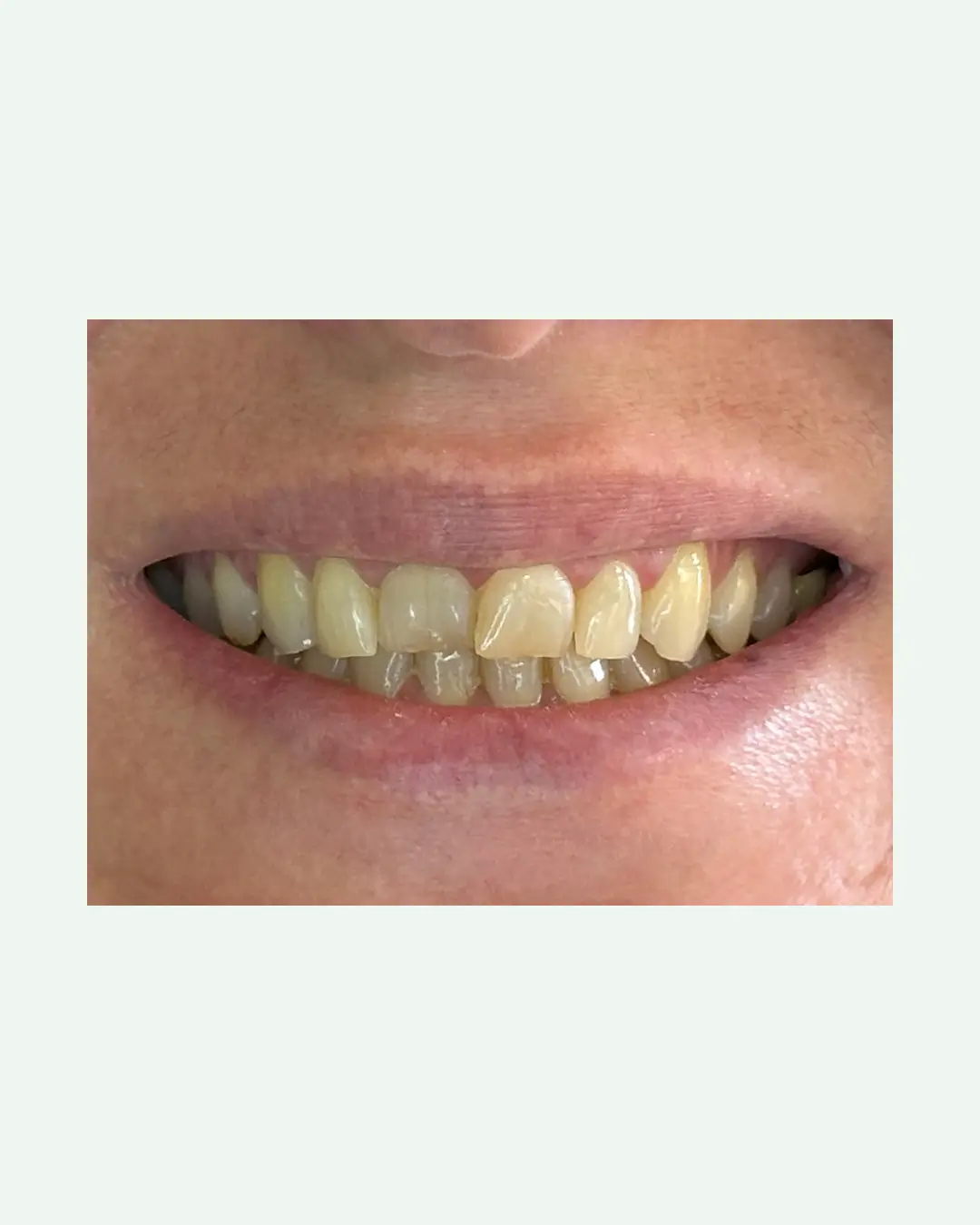 Before porcelain veneer smile makeover consultation for dental tourism