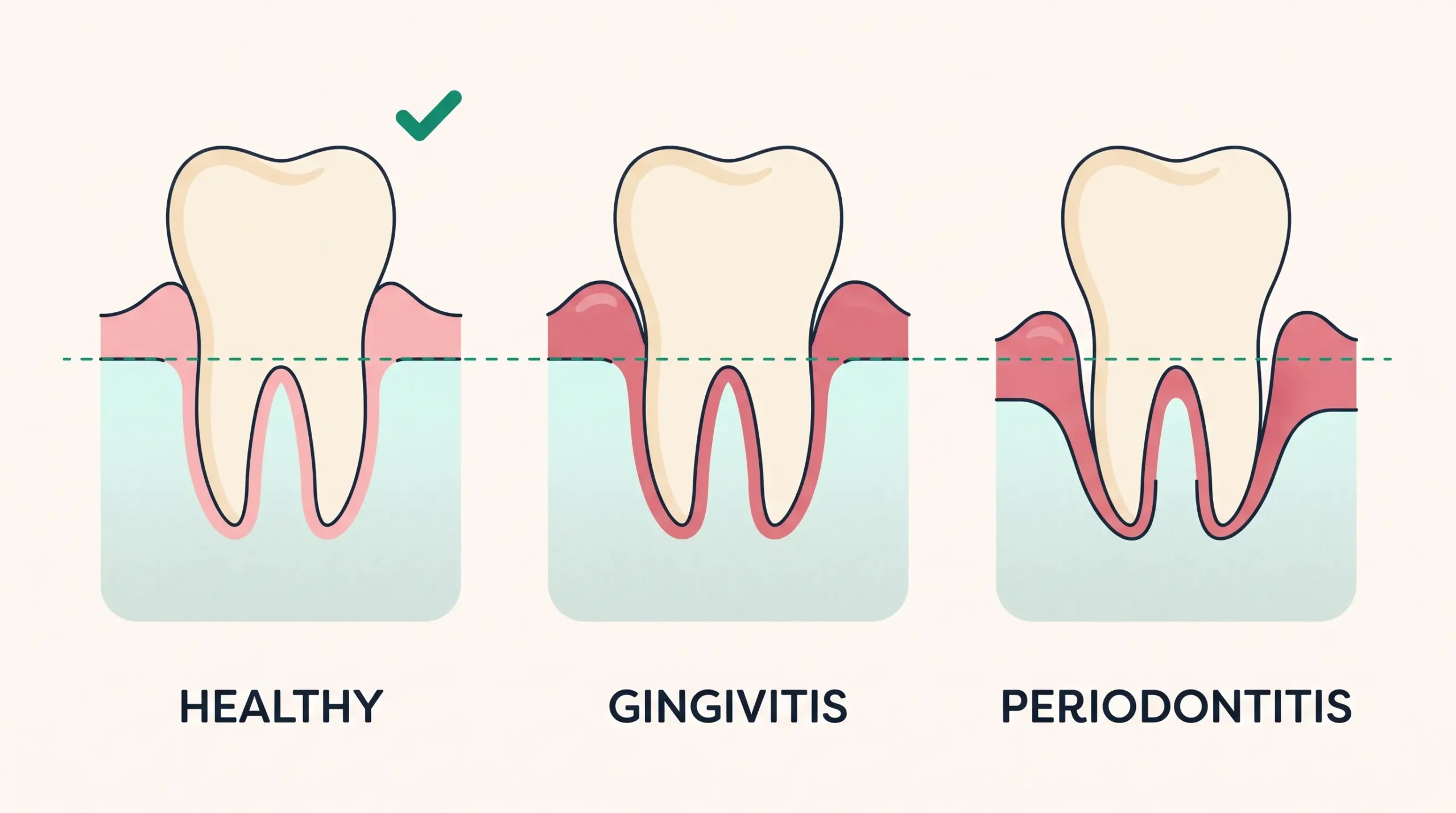 Gum disease and dental implants periodontal treatment before implant placement in Albania