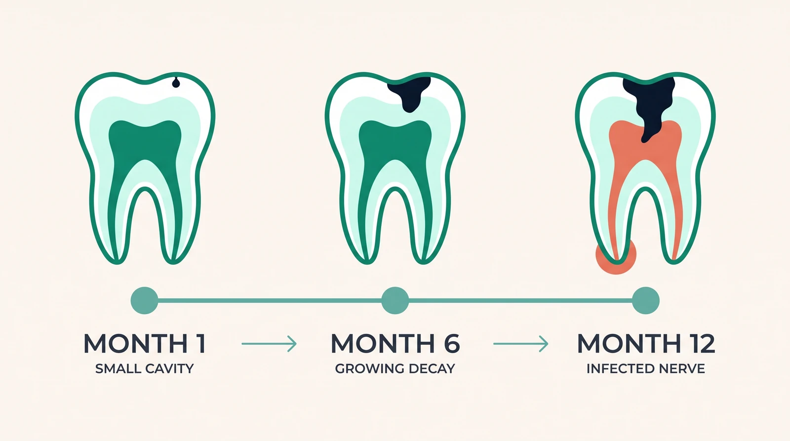 Tooth decay progression from a small cavity at month 1 to growing decay at month 6 and an infected nerve at month 12